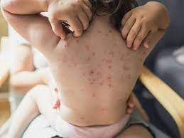 Does My Child Have Chickenpox?